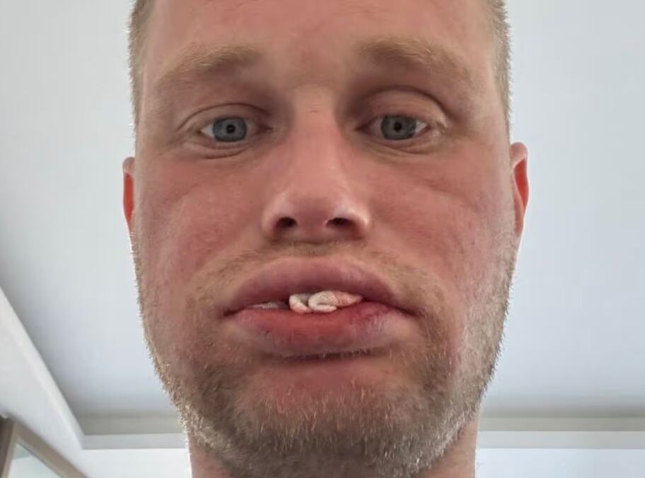 Otišao sam u Tursku da jeftino sredim zube, a sad nemam nijedan: Kad se probudio iz anestezije ostao je sleđen