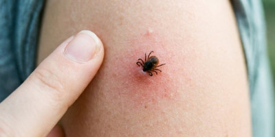 Greška koju mnogi prave kad vade krpelja: Lekari otkrili šta nikako ne smete da radite