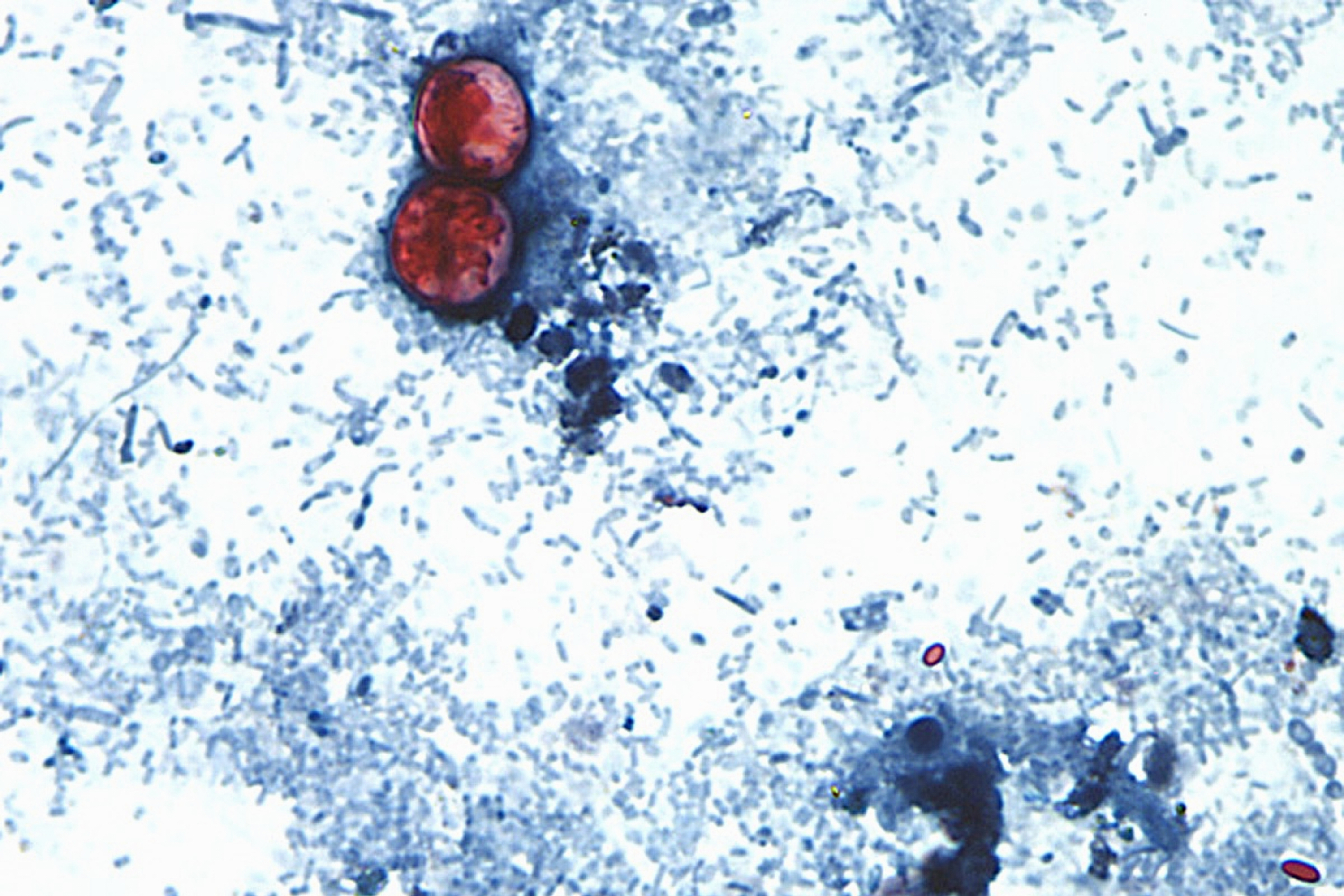 U.S. identifies cyclosporiasis cases in 4 more states, widening investigation