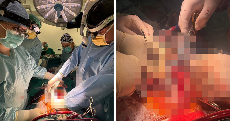 Povijesna operacija u Splitu, pacijentu ugradili umjetno srce. “Bio je na rubu smrti”