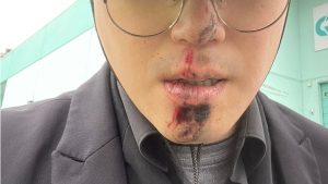 Vancouver Hong Kong Activist Keung Ka-wai Injured in Suspected Deliberate Vehicle Attack