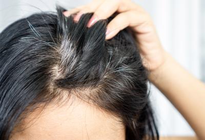 T - ZONA GLAVE JE MESTO GDE POČINJE PROREĐIVANJE KOSE: "Ti delovi su posebno ranjivi"